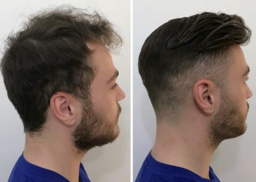 hair replacement melbourne