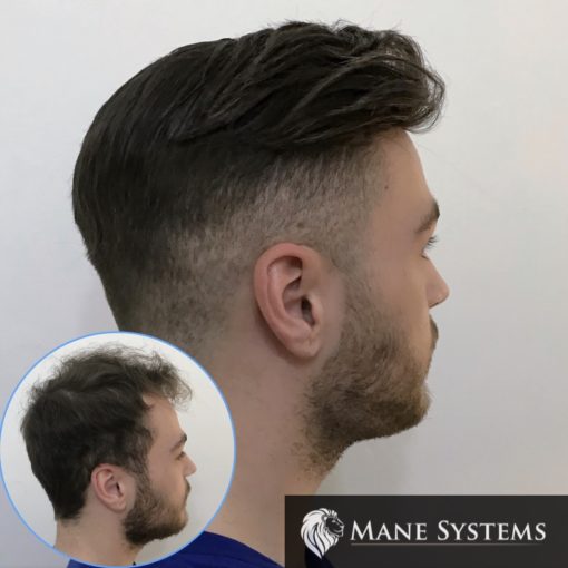 hair system before and after result